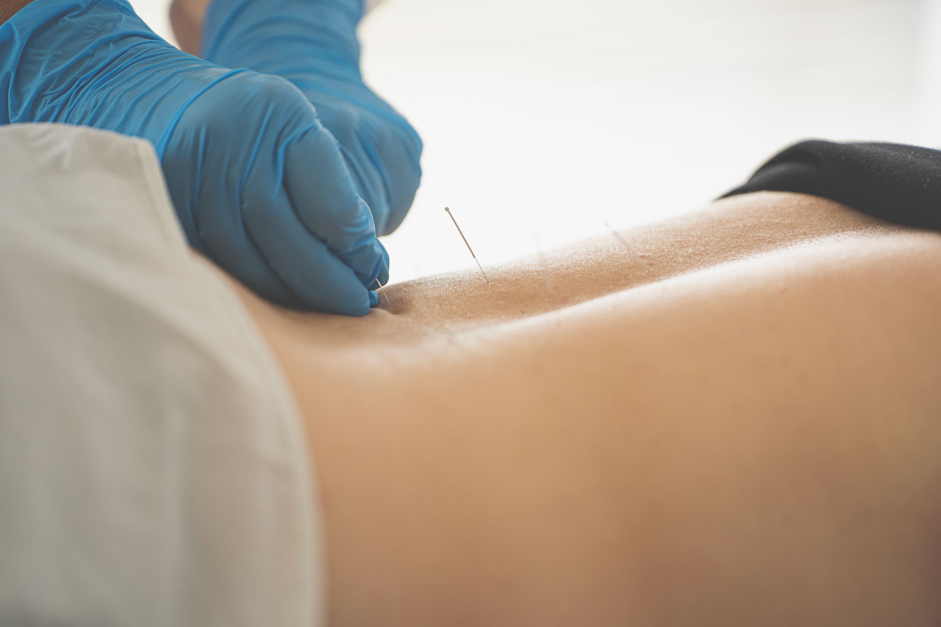 Acupuntura